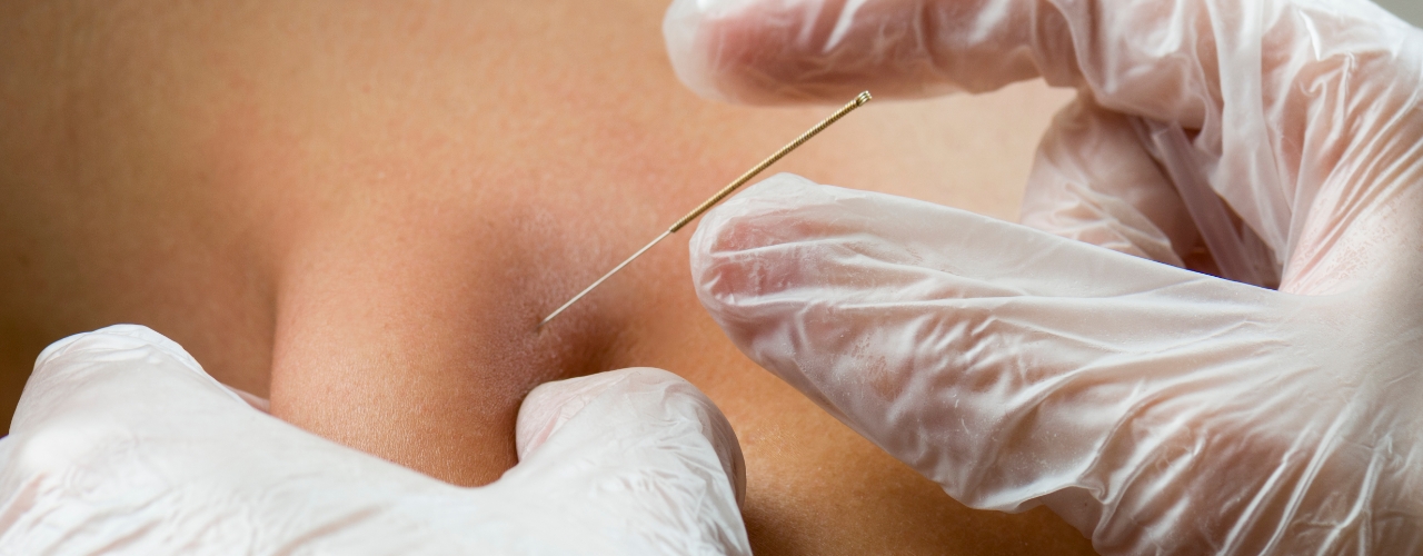 Dry-needling-legacy-physical-therapy-and-wellness-Naperville-IL