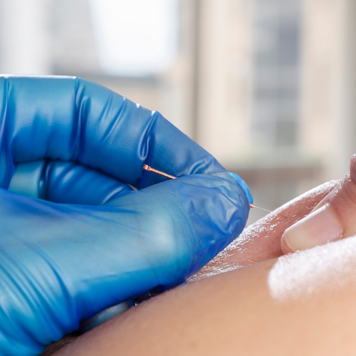 Dry-needling-legacy-physical-therapy-and-wellness-Naperville-IL