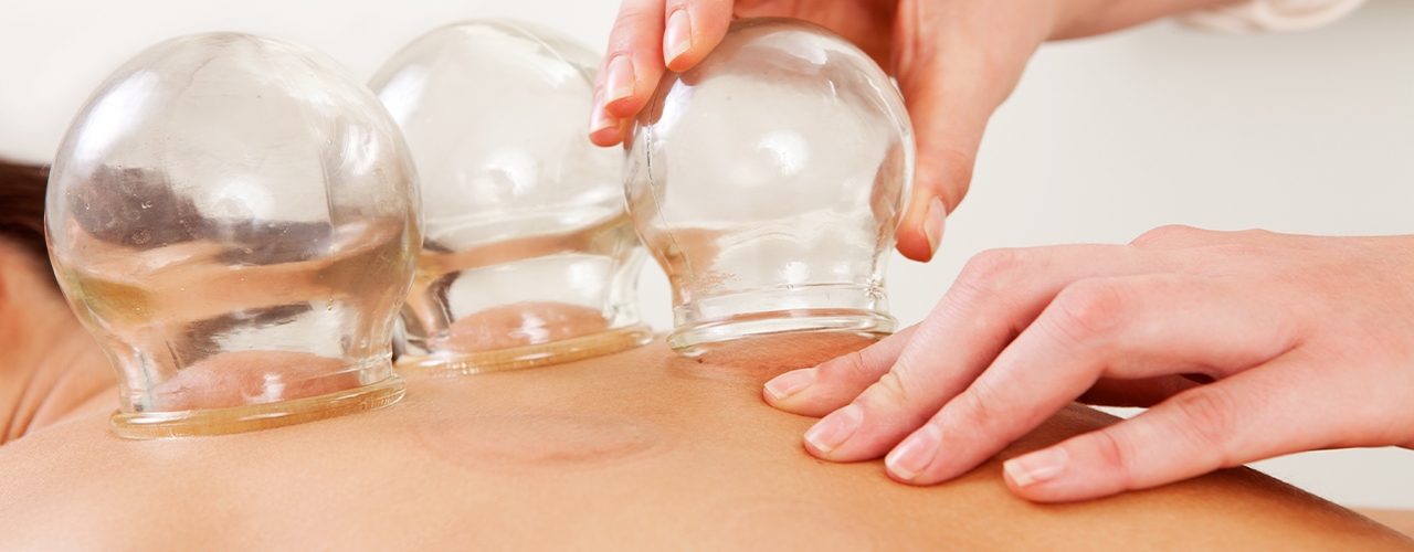 cupping-Legacy-Physical-Therapy-and-Wellness-Naperville-IL